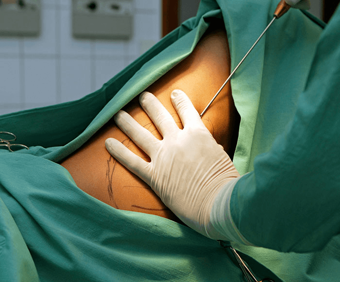 A woman is said to be in “critical care” after being subjected to a liposuction 